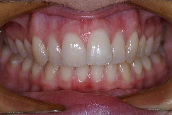 Décalage maxillo mandibulaire traité par gouttières