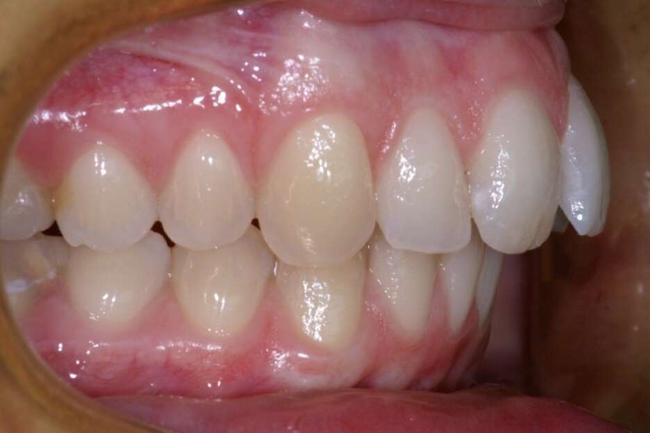 Biprotrusionet encombremets appareillage lingual avec 4 extractions
