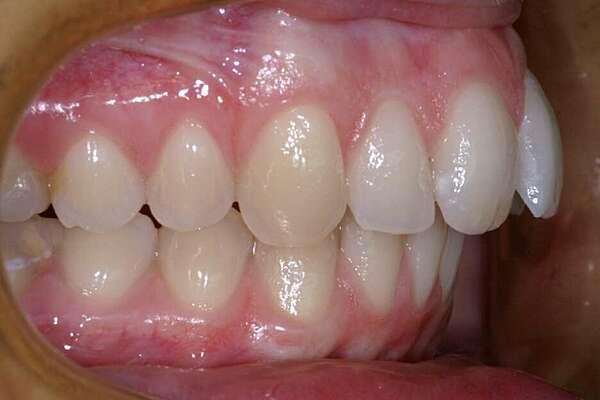 Biprotrusionet encombremets appareillage lingual avec 4 extractions