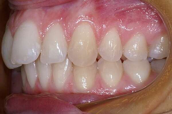 Biprotrusionet traitée sans extractiion