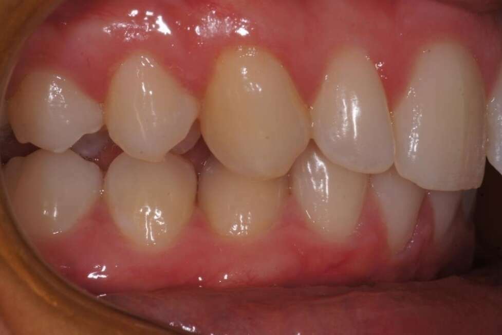 Décalage squelettique traitement ortho chirurgical par gouttières