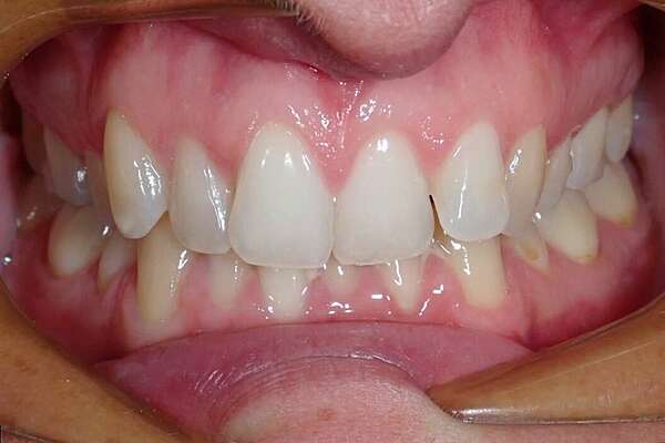 Grand dysharmonie traitée par gouttières