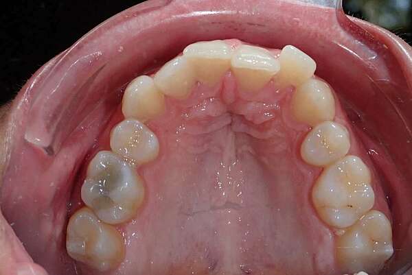 Cas chirurgical préparé en technique linguale
