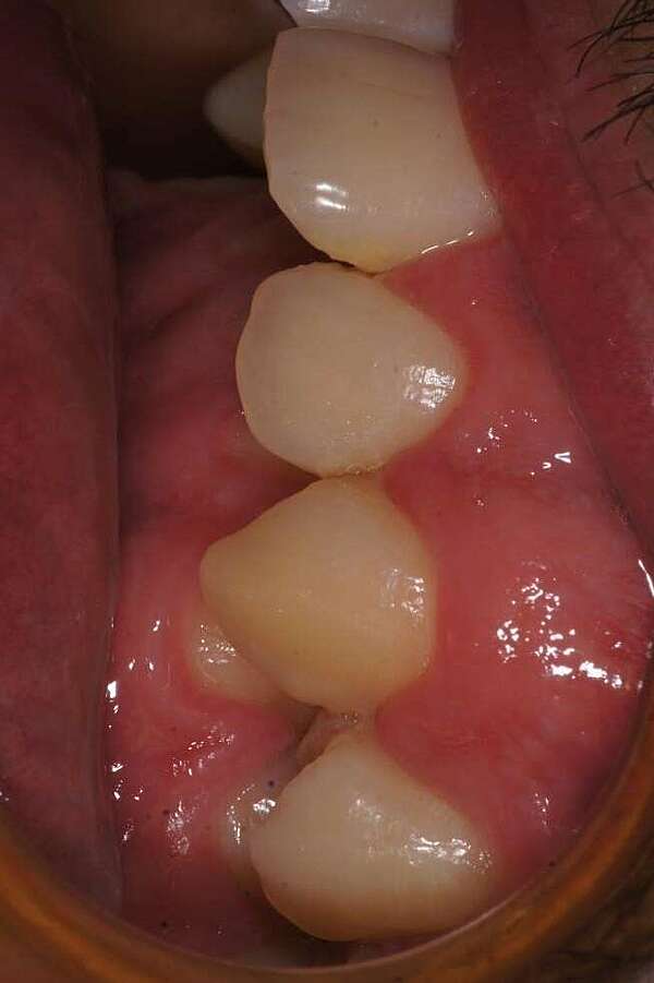 Gros décalage squelettique traité par  gouttières et chirurgie