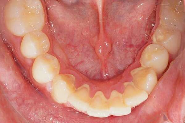 Mise en place d'une canine incluse en technique linguale