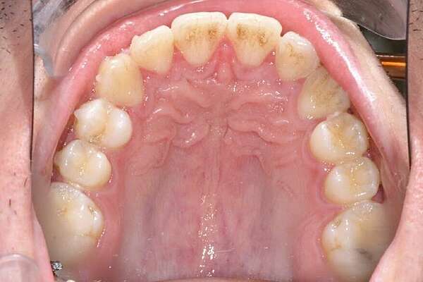 Prognathisme traitée en technique lingual