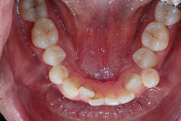 Important encombrement traité par gouttières