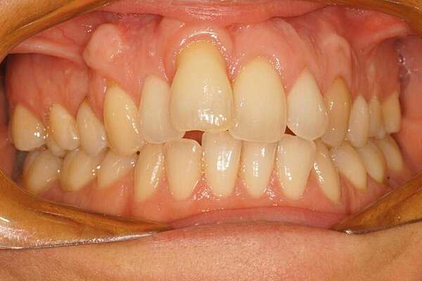 Rédicive d'un traitement dans l'enfance repris avec des gouttières