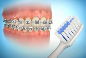 Brossage des dents avec des brackets