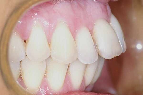 Reprise de traitement d'un patient ayant eu un traitement dans l'enfance