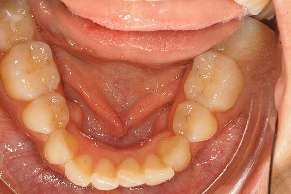 Reprise de récidive par gouttières