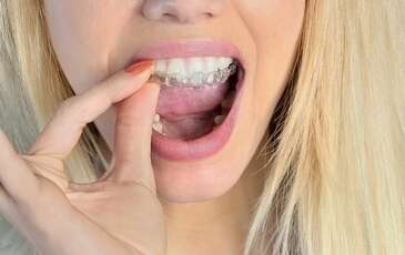 L'orthodontie invisible