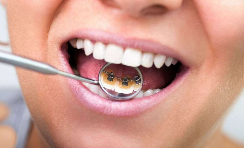 L'ORTHODONTIE LINGUALE OU ORTHODONTIE INVISIBLE