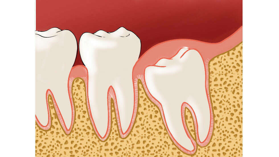 LES DENTS DE SAGESSE