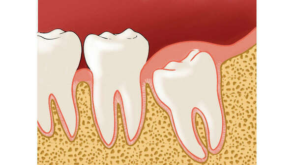 LES DENTS DE SAGESSE