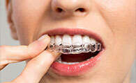 LA TECHNIQUE INVISALIGN® ALIGN TECHNOLOGY