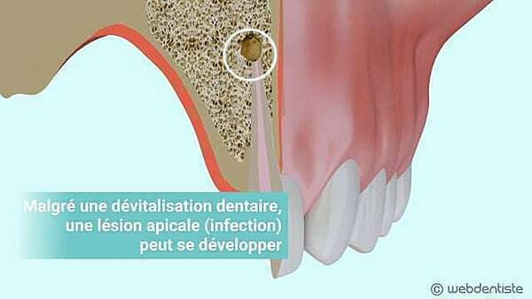 La résection apicale