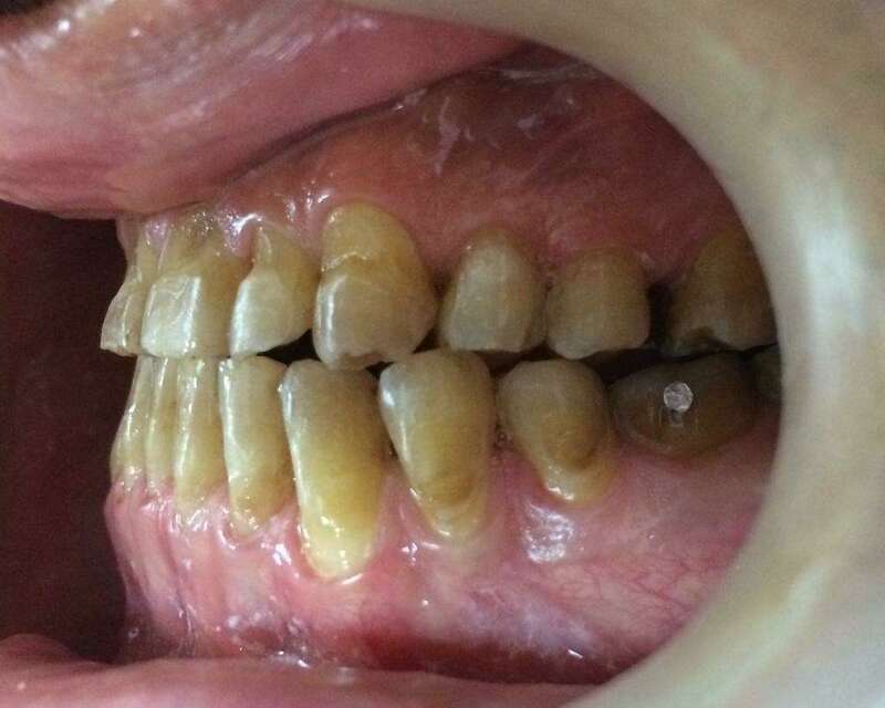 Traitement simplement orthodontique après