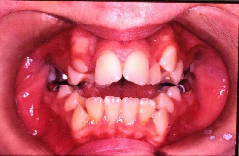 Traitement simplement avec un appareillage avant