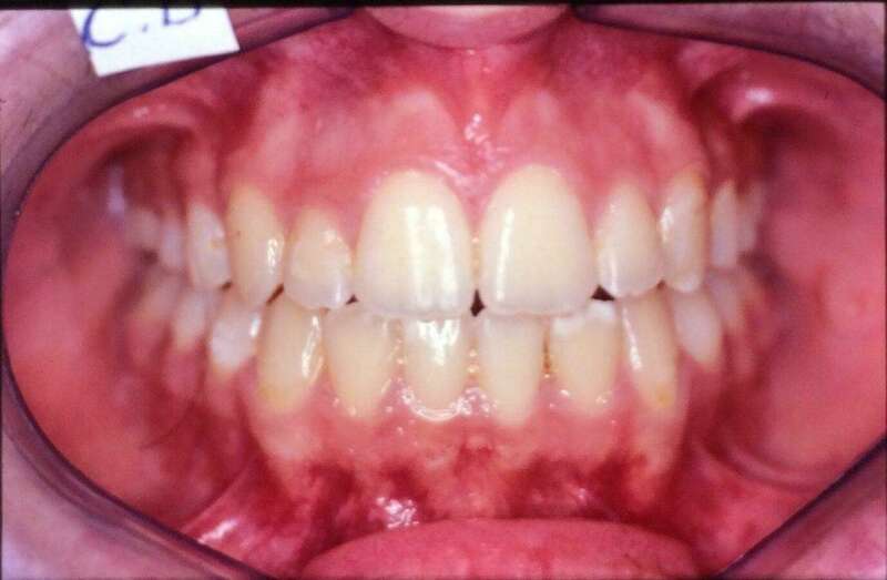 Traitement simplement avec un appareillage après