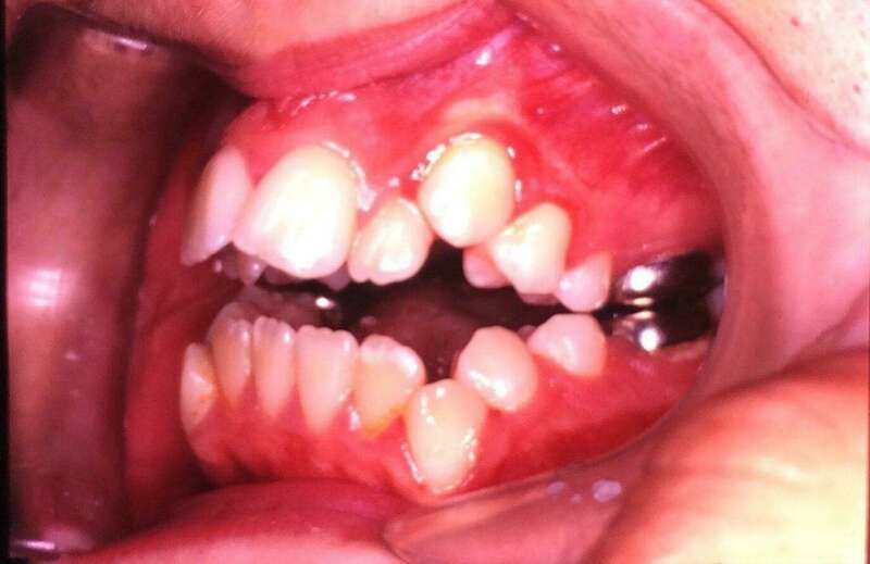 Traitement problème squelettique osseux avant