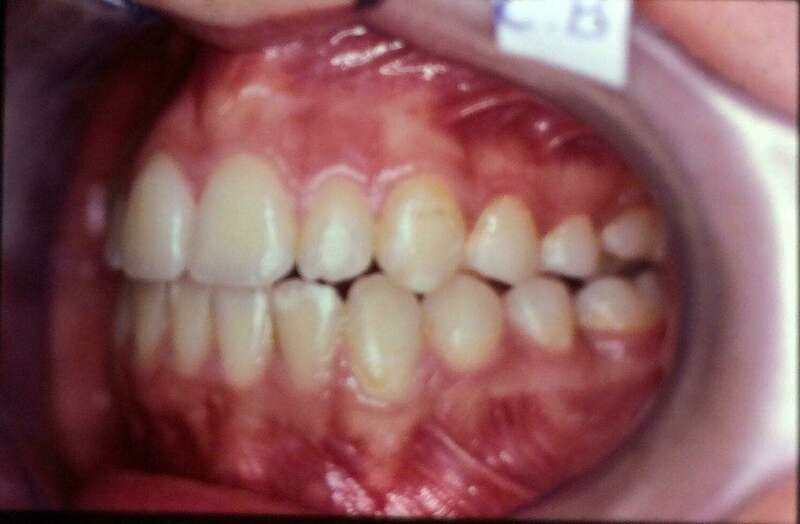 Traitement problème squelettique osseux après