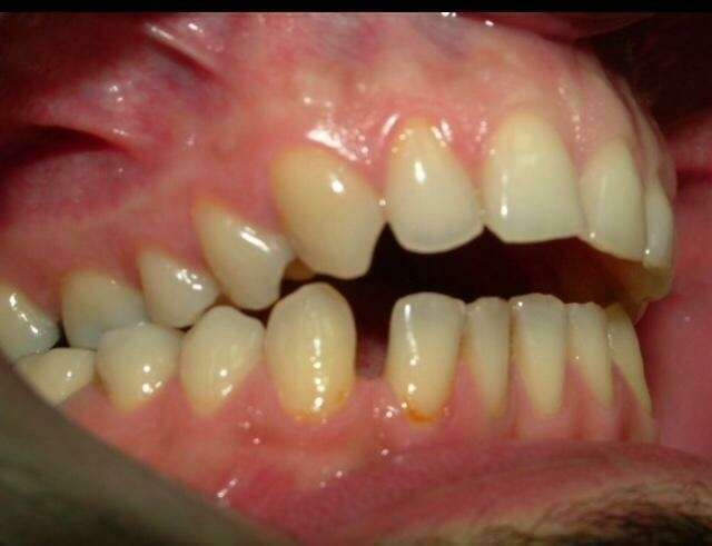 Traitement orthodontique d'un cas sévère avant