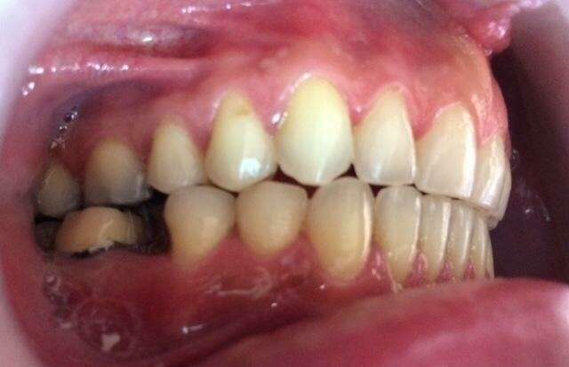 Traitement orthodontique d'un cas sévère après