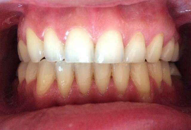 Extractions dentaires et chirurgie maxillo-faciale après