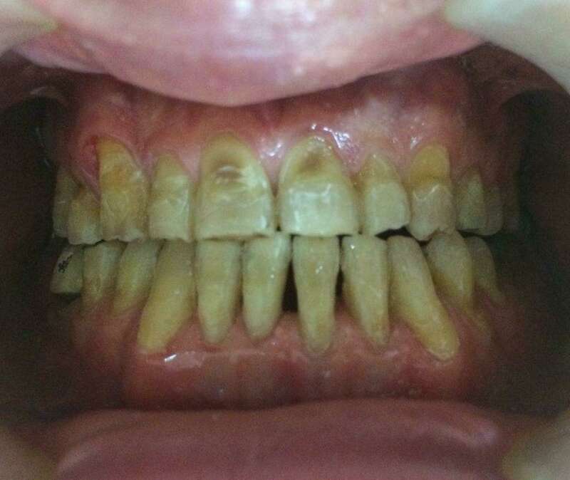 Après traitement simplement orthodontique