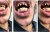 Patient avec dents supérieures très cariées et délabrées