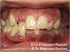 Traitement orthodontie cas 3 avant