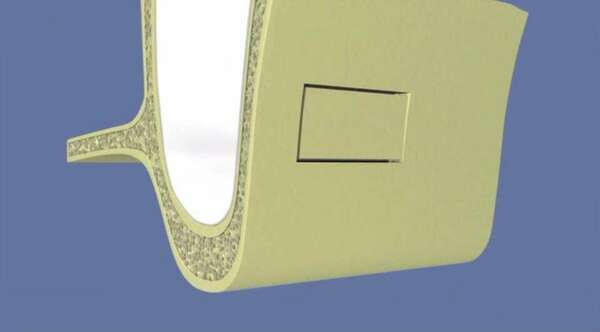 Comblement de sinus par abord latéral sans pose d’implant
