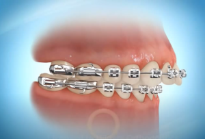 Les élastiques en orthodontie - Class II