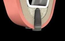La greffe osseuse intra sinusienne ou Sinus Lift