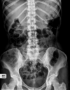 radiographie lombaires cruralgie