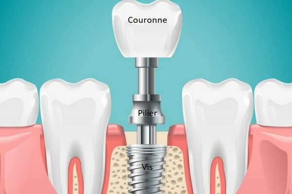 Les différentes pièces d’un implant