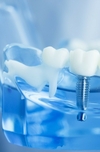 Implant dentaire