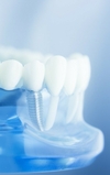 Implant dentaire