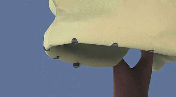 Maxillaire all-on-6 et comblement de sinus