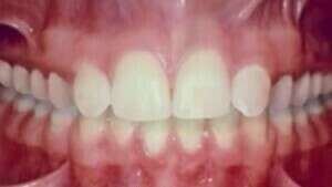 Agénésies des incisives latérales - Traitement par fermeture