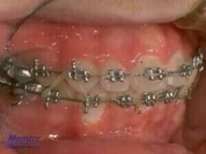 Élastiques verticaux