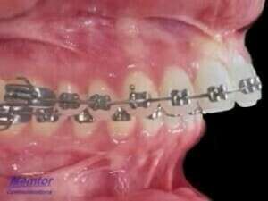 Élastiques de Classe 2