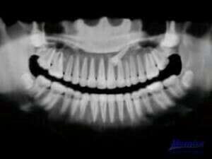 Radiographie - traction orthodontique d'une canine incluse :