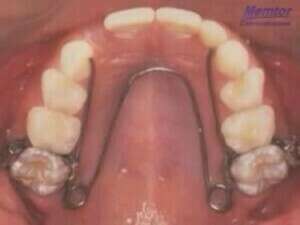 Expansion Par Quad Hélix