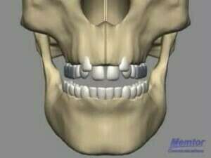 Expansion par disjonction - Vue osseuse