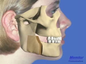 Avancée mandibulaire - Vue de profil