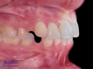 Encombre supérieur et inférieur - Traitement par 4 Extractions