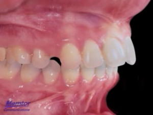 Extraction des prémolaires supérieures