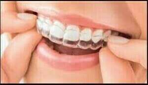 Orthodontie invisible Primo*